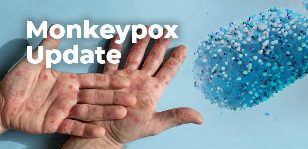 monkeypox update - pair of hands with blisters on them