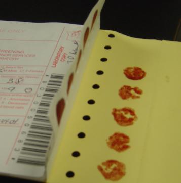 an example of a specimen that had the filter scratched, torn or abraded