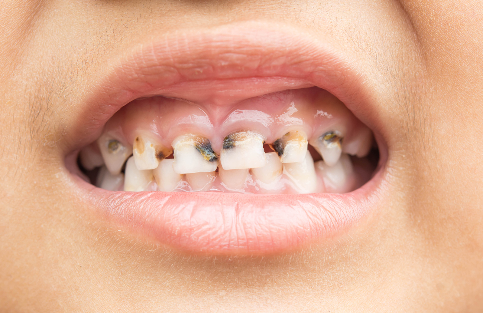 mouth of child with broken teeth