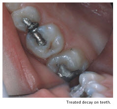 treated decay on teeth
