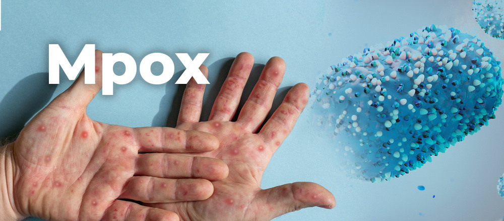 Mpox update - pair of hands with blisters on them